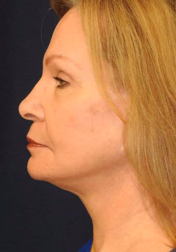 Facial Fat Grafting before and after, case 3282 - Cool Springs Plastic Surgery