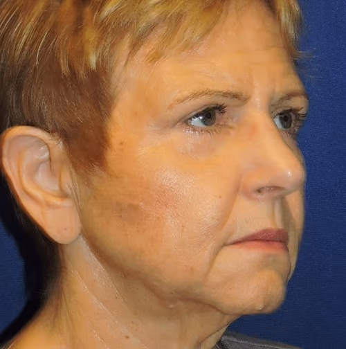 Eyelid Surgery before and after, case 3308 - Cool Springs Plastic Surgery