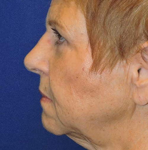 Eyelid Surgery before and after, case 3308 - Cool Springs Plastic Surgery
