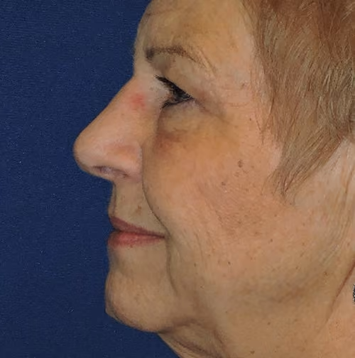 Eyelid Surgery before and after, case 3308 - Cool Springs Plastic Surgery