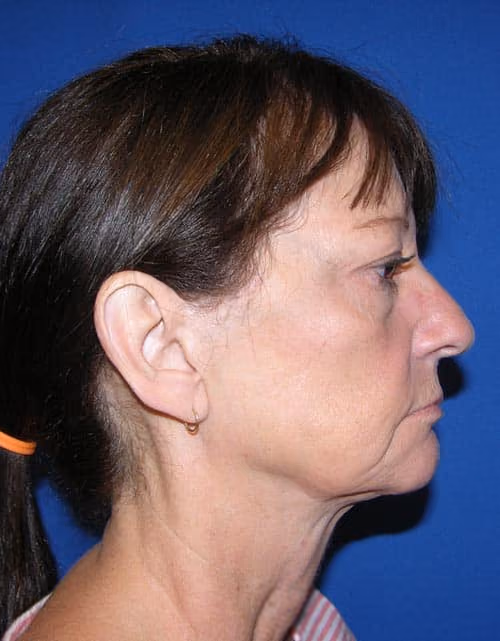 Facial Fat Grafting before and after, case 4462 - Cool Springs Plastic Surgery