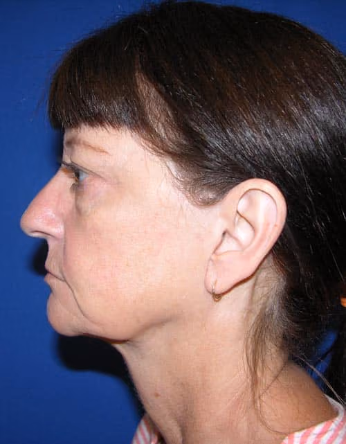 Facial Fat Grafting before and after, case 4462 - Cool Springs Plastic Surgery