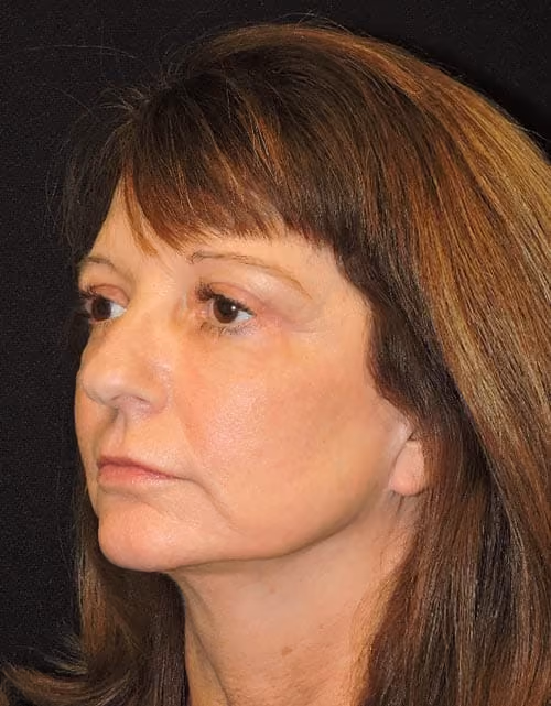 Facial Fat Grafting before and after, case 4462 - Cool Springs Plastic Surgery
