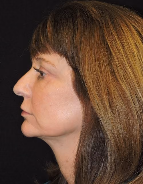 Facial Fat Grafting before and after, case 4462 - Cool Springs Plastic Surgery