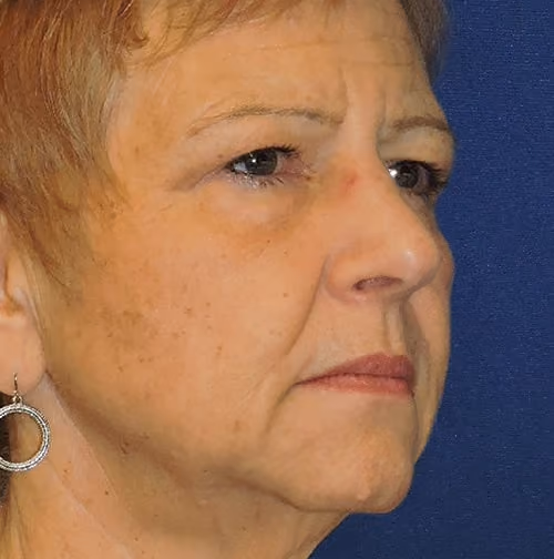 Eyelid Surgery before and after, case 3308 - Cool Springs Plastic Surgery