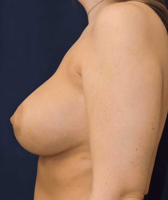 Breast Implant Revision before and after, case 572 - Cool Springs Plastic Surgery
