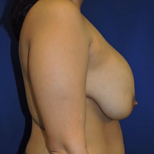 Breast Implant Revision before and after, case 982 - Cool Springs Plastic Surgery