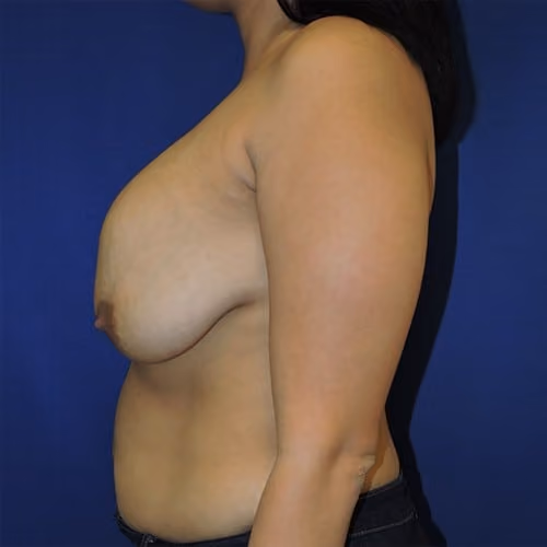 Breast Implant Revision before and after, case 982 - Cool Springs Plastic Surgery