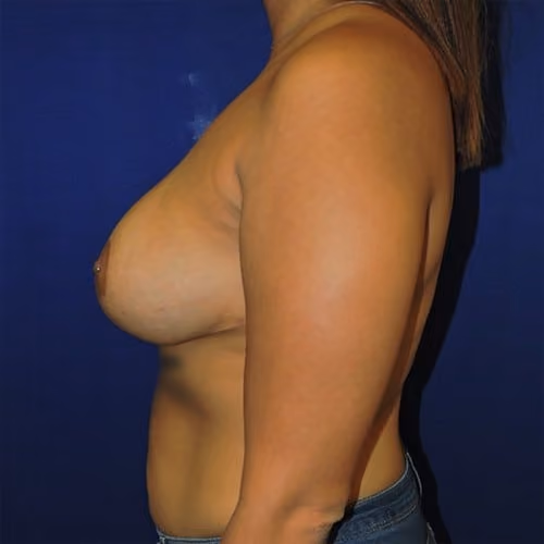 Breast Implant Revision before and after, case 982 - Cool Springs Plastic Surgery