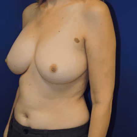 Breast Implant Revision before and after, case 1255 - Cool Springs Plastic Surgery