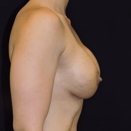 Breast Implant Revision before and after, case 1425 - Cool Springs Plastic Surgery