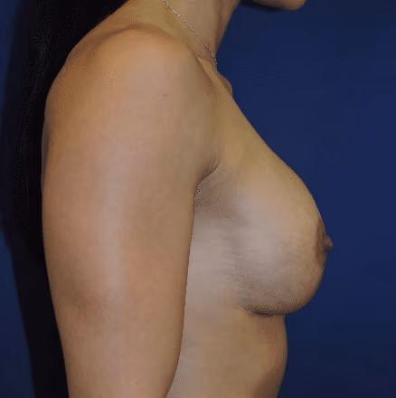 Breast Implant Revision before and after, case 1425 - Cool Springs Plastic Surgery
