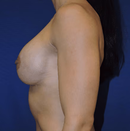Breast Implant Revision before and after, case 1425 - Cool Springs Plastic Surgery
