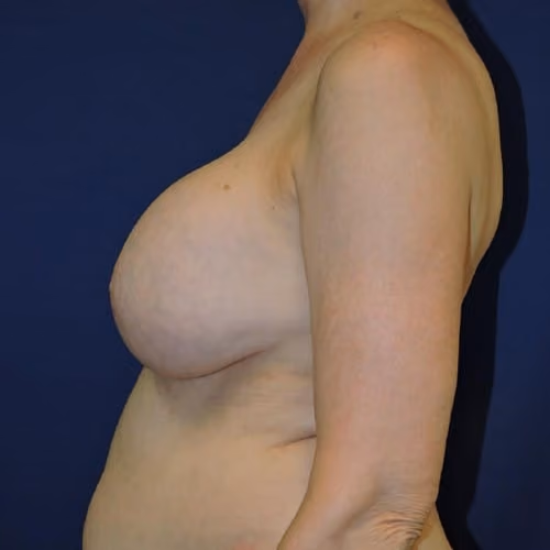 Breast Implant Revision before and after, case 1688 - Cool Springs Plastic Surgery