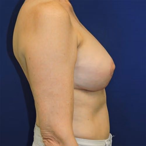 Breast Implant Revision before and after, case 1838 - Cool Springs Plastic Surgery