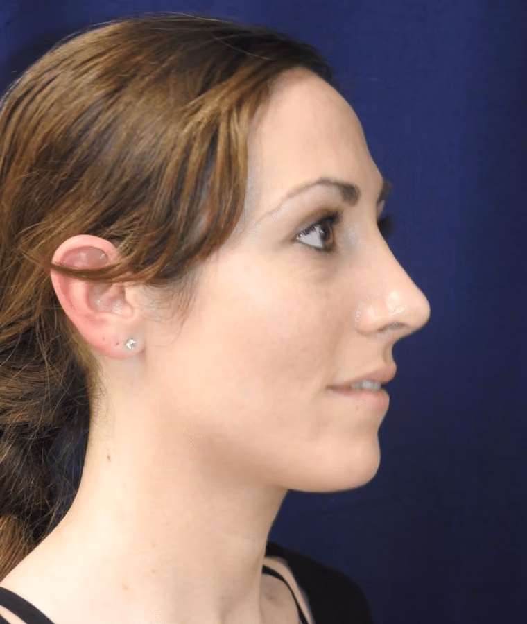 Rhinoplasty before and after, case 1879 - Cool Springs Plastic Surgery