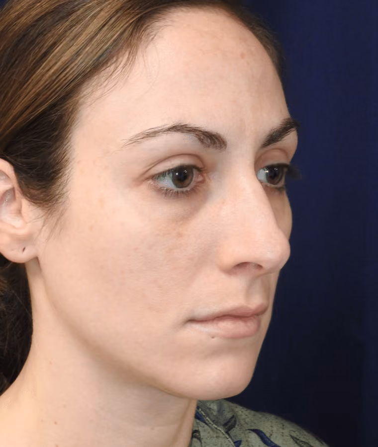 Rhinoplasty before and after, case 1879 - Cool Springs Plastic Surgery