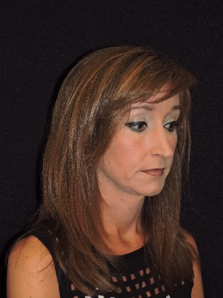 Rhinoplasty before and after, case 2091 - Cool Springs Plastic Surgery