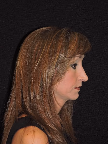 Rhinoplasty before and after, case 2091 - Cool Springs Plastic Surgery