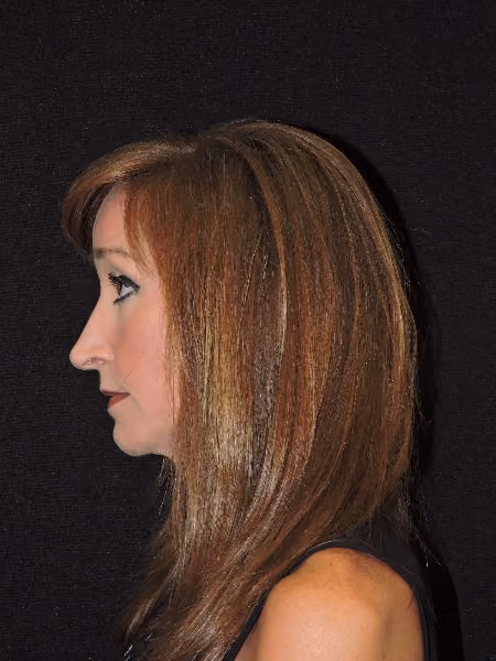 Rhinoplasty before and after, case 2091 - Cool Springs Plastic Surgery