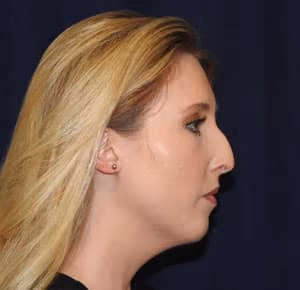 Rhinoplasty before and after, case 2269 - Cool Springs Plastic Surgery