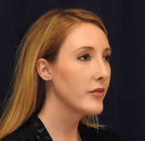 Rhinoplasty before and after, case 2269 - Cool Springs Plastic Surgery