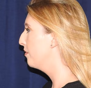 Rhinoplasty before and after, case 2269 - Cool Springs Plastic Surgery