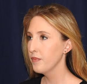 Rhinoplasty before and after, case 2269 - Cool Springs Plastic Surgery