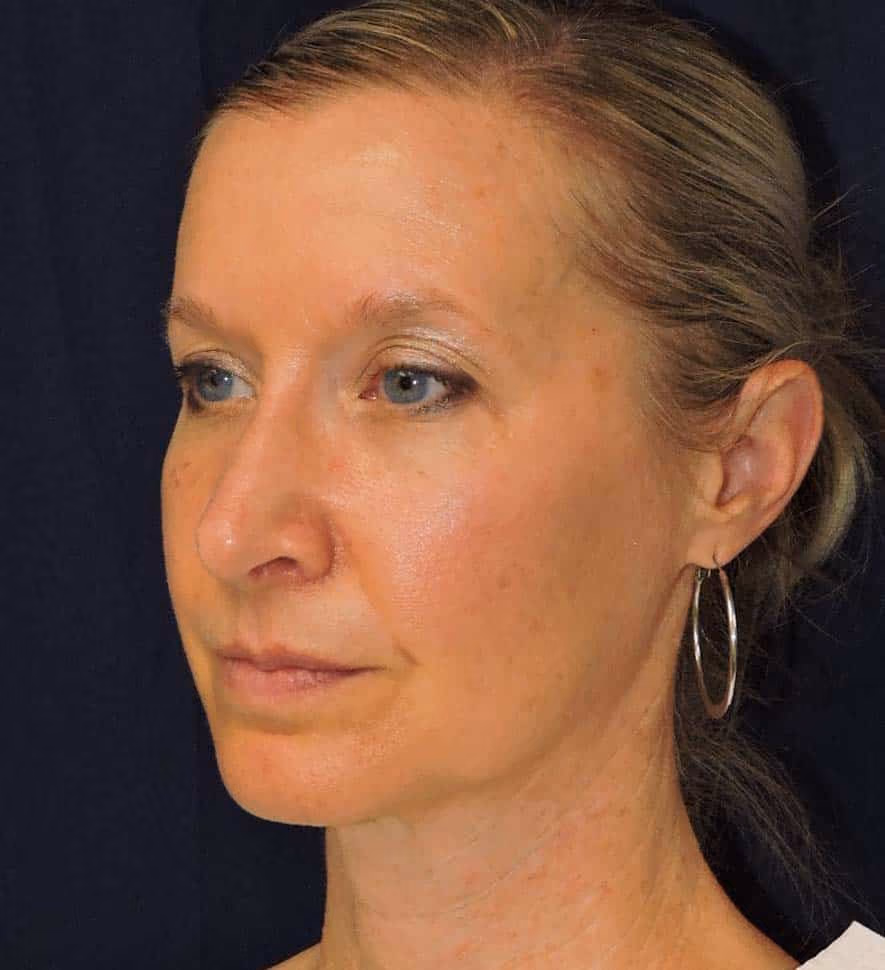 Rhinoplasty before and after, case 2401 - Cool Springs Plastic Surgery
