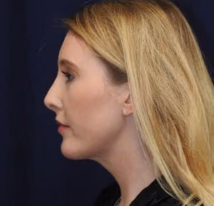 Rhinoplasty before and after, case 2269 - Cool Springs Plastic Surgery