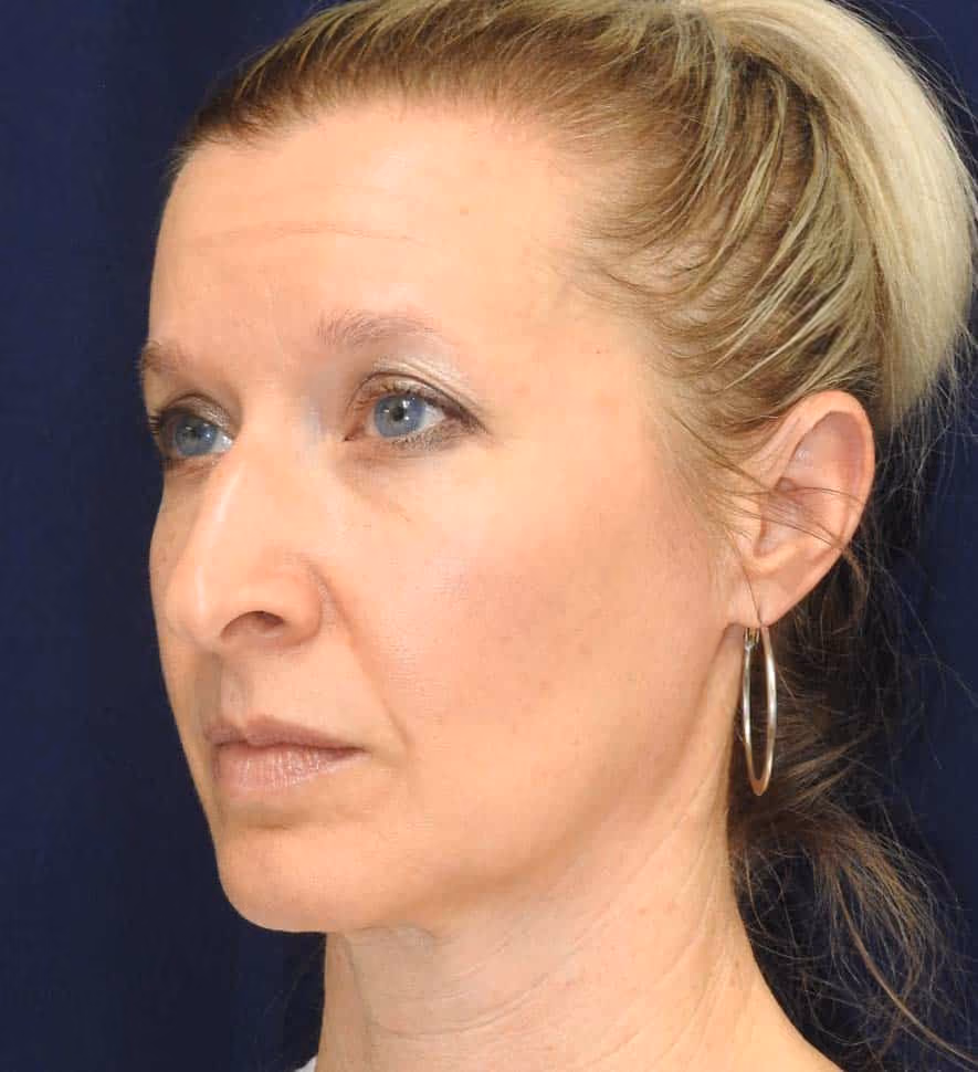 Rhinoplasty before and after, case 2401 - Cool Springs Plastic Surgery