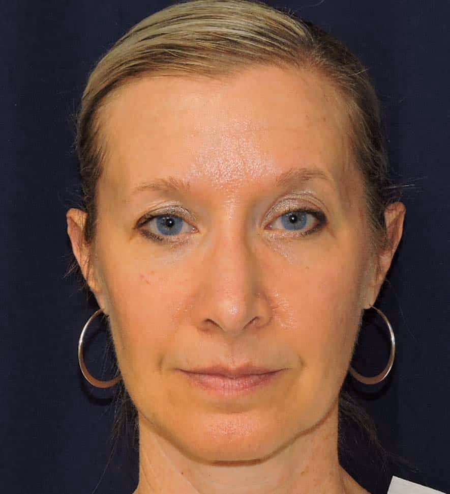 Rhinoplasty before and after, case 2401 - Cool Springs Plastic Surgery