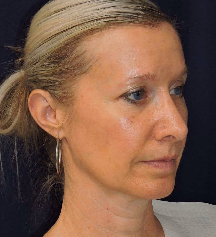 Rhinoplasty before and after, case 2401 - Cool Springs Plastic Surgery