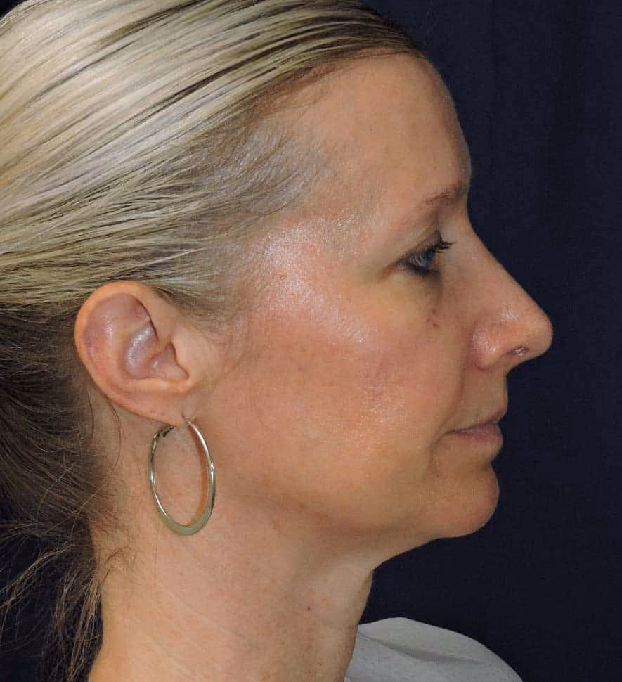 Rhinoplasty before and after, case 2401 - Cool Springs Plastic Surgery