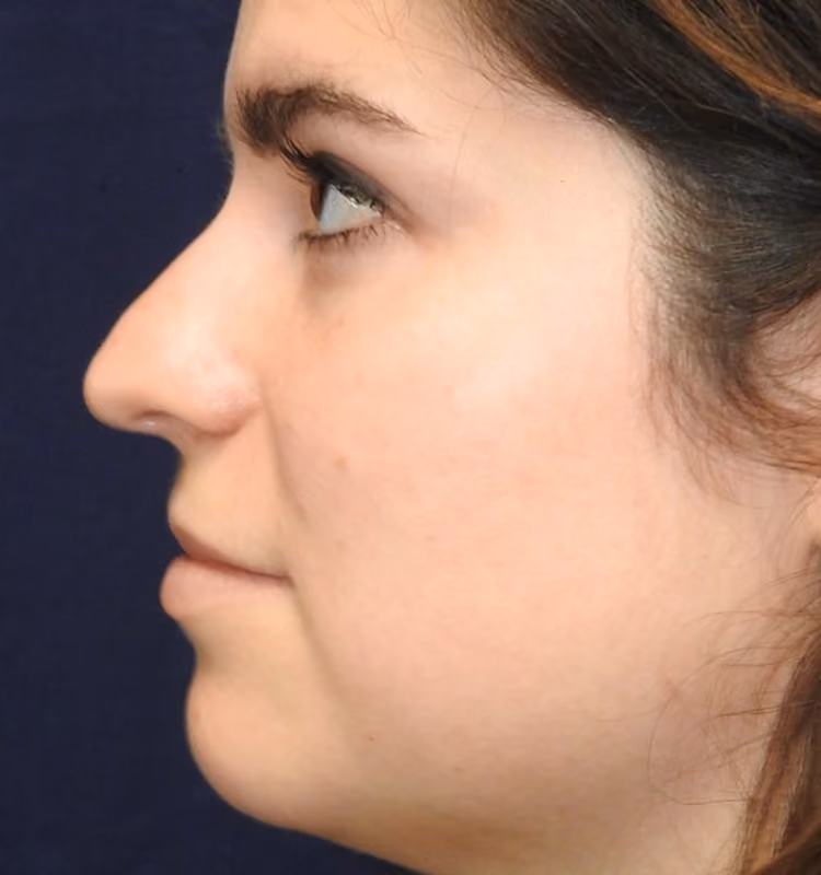 Rhinoplasty before and after, case 2565 - Cool Springs Plastic Surgery