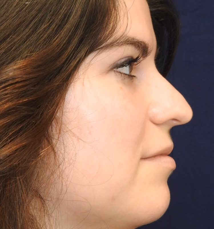 Rhinoplasty before and after, case 2565 - Cool Springs Plastic Surgery
