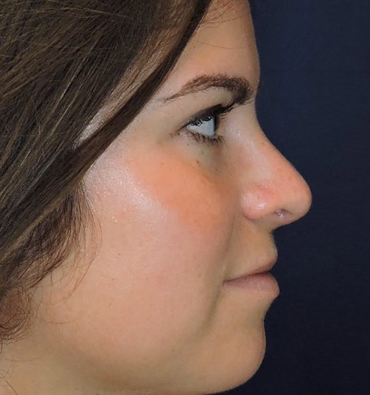 Rhinoplasty before and after, case 2565 - Cool Springs Plastic Surgery