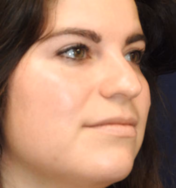 Rhinoplasty before and after, case 2565 - Cool Springs Plastic Surgery