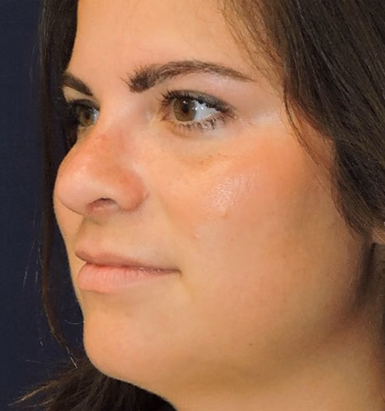 Rhinoplasty before and after, case 2565 - Cool Springs Plastic Surgery