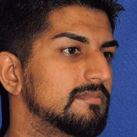Rhinoplasty before and after, case 2861 - Cool Springs Plastic Surgery