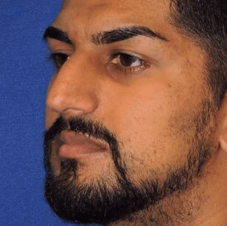 Rhinoplasty before and after, case 2861 - Cool Springs Plastic Surgery