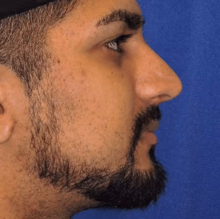 Rhinoplasty before and after, case 2861 - Cool Springs Plastic Surgery