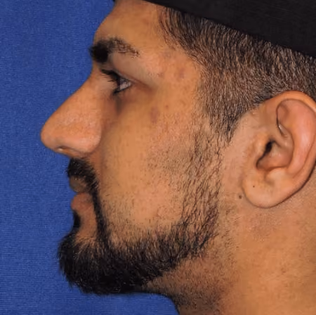 Rhinoplasty before and after, case 2861 - Cool Springs Plastic Surgery