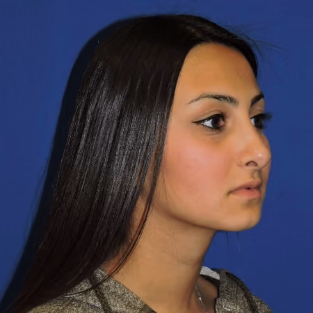 Rhinoplasty before and after, case 2877 - Cool Springs Plastic Surgery