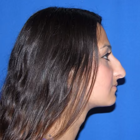 Rhinoplasty before and after, case 2877 - Cool Springs Plastic Surgery