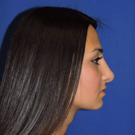 Rhinoplasty before and after, case 2877 - Cool Springs Plastic Surgery