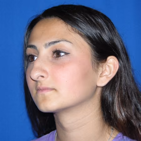 Rhinoplasty before and after, case 2877 - Cool Springs Plastic Surgery