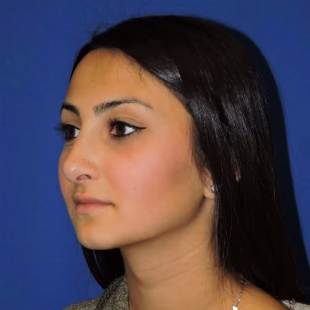 Rhinoplasty before and after, case 2877 - Cool Springs Plastic Surgery