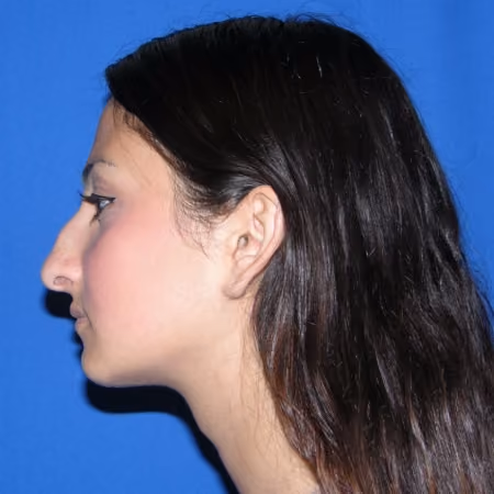 Rhinoplasty before and after, case 2877 - Cool Springs Plastic Surgery