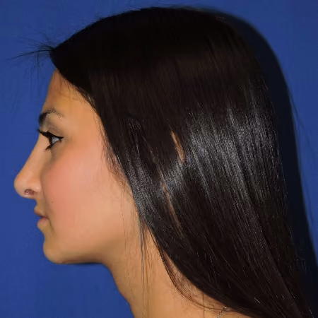Rhinoplasty before and after, case 2877 - Cool Springs Plastic Surgery